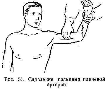 Кровотечение из верхней трети плеча. Кровотечение плечевой артерии. Наложение жгута на верхнюю треть плеча. Кровотечение из верхней трети плеча. Кровотечение из верхней трети плеча.