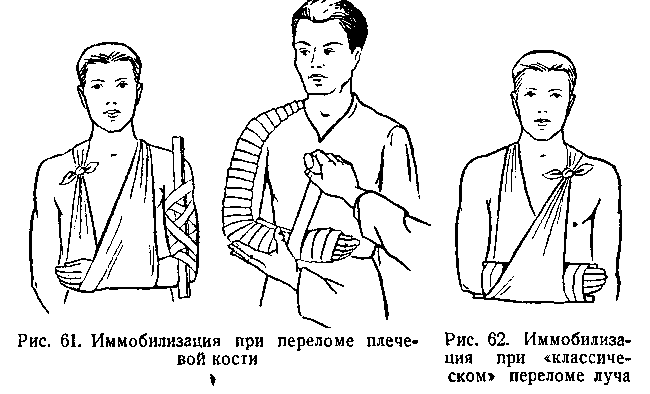 транспортная иммобилизация при переломе плечевой кости тест. транспортная иммобилизация при переломе плечевой кости тест. иммобилизация при переломе плечевой кости осуществляется. перелом плечевой кости транспортная иммобилизация шиной. транспортная иммобилизация при переломе плечевой кости тест.